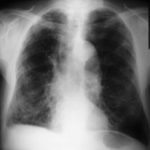 La exposición laboral a tóxicos inhalados causa más EPOC en España que la exposición al humo de la biomasa.